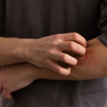 Picaduras de insecto